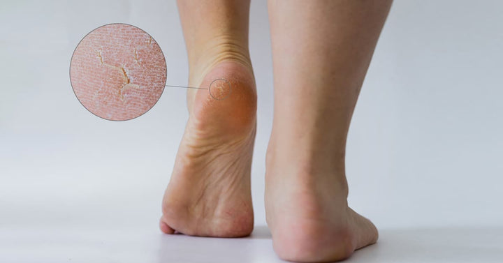 Never Worry About Dry And Cracked Or Itchy Feet Again With This Essential  Trick