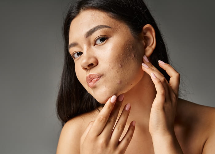 Sunscreen For Acne Prone Skin