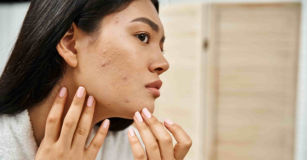 Bacterial Acne vs Hormonal Acne