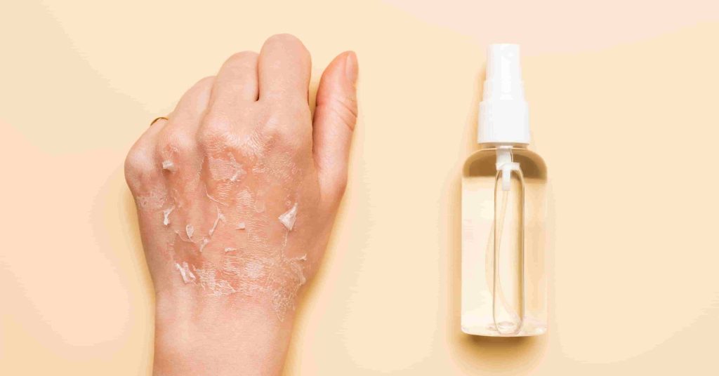 skin peeling on hand