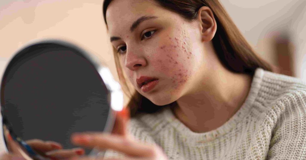 Acne-prone skin