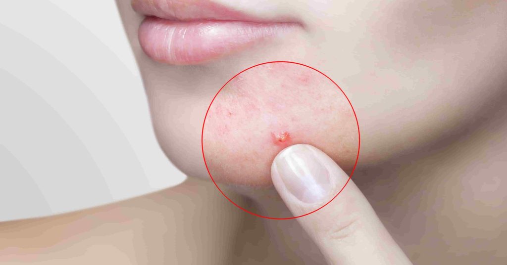 Acne Breakout on Face