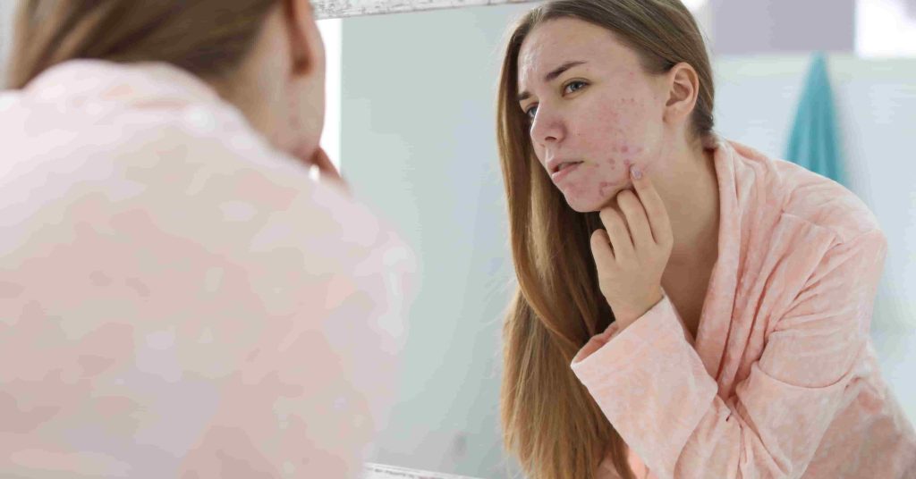 adult acne