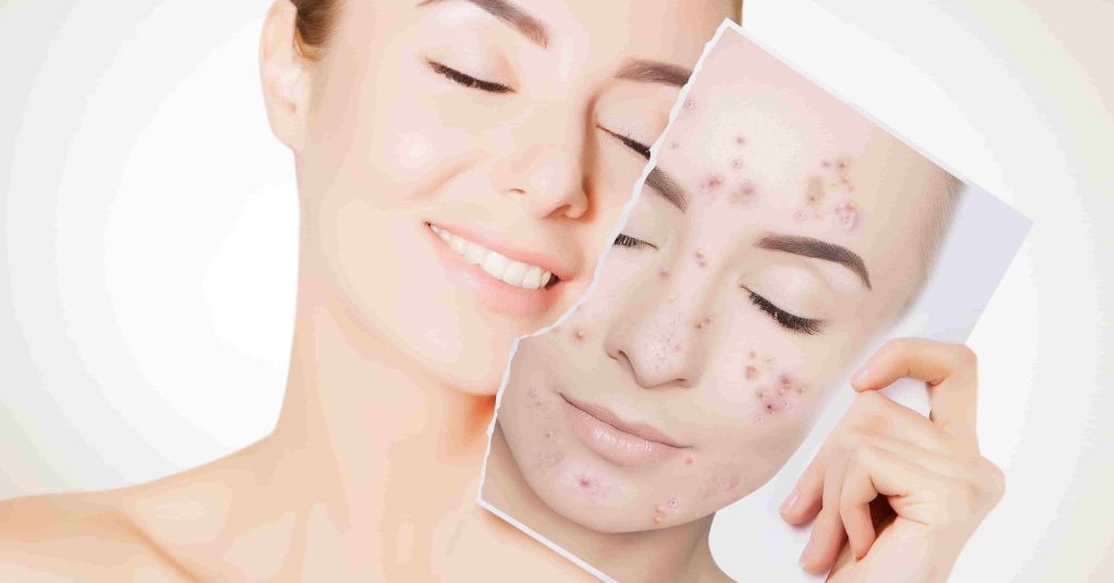 Dry Skin Acne