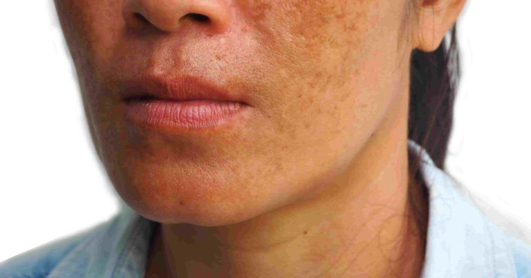 Say Goodbye to Sunspots on Face with 9 Expert-Backed Remedies