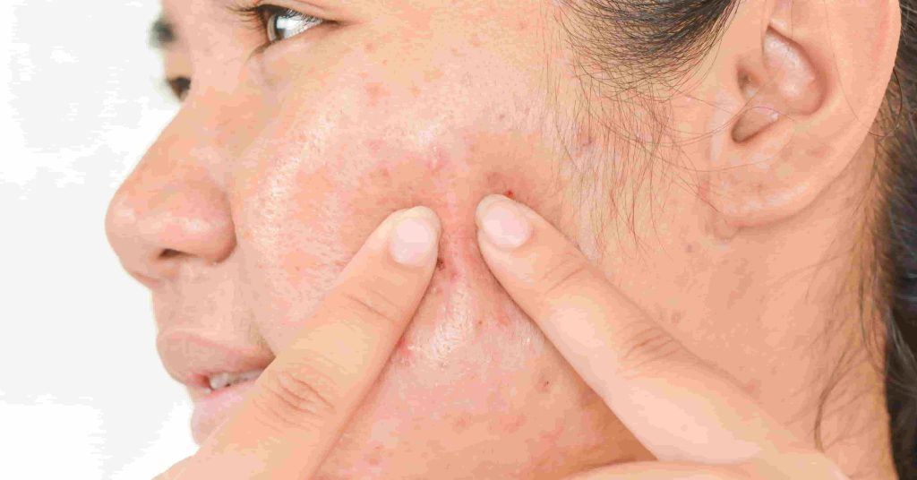 acne lesions