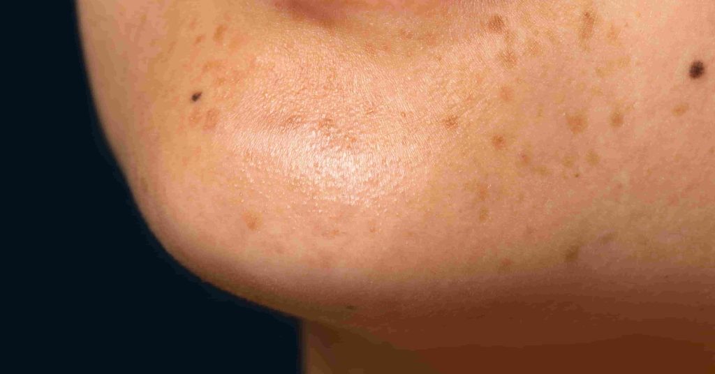 Dark Patches around mouth