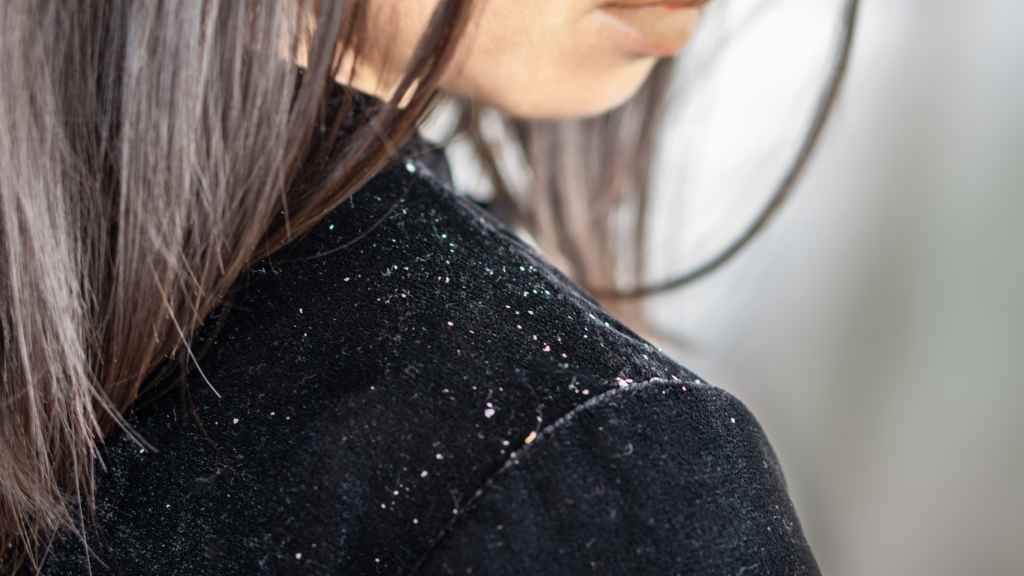 Home Remedies for Dandruff