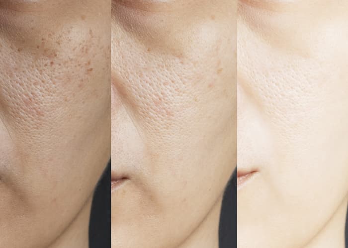 Transformative Results Before And After Exfoliation