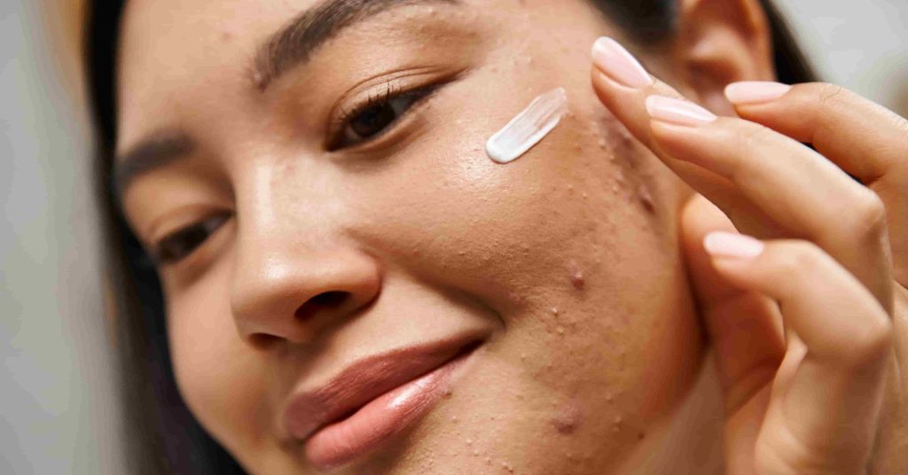 Moisturizer for Acne prone skin