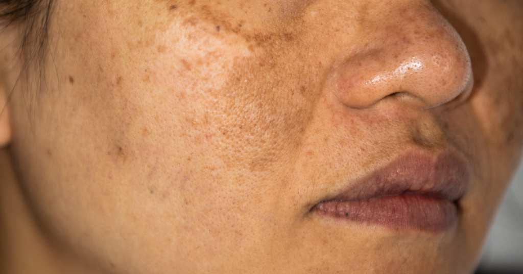 Melasma on face