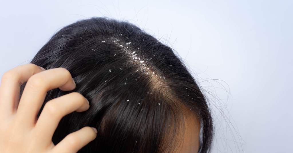 How to get rid of dandruff