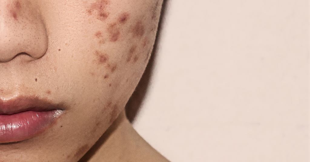 Seborrheic Dermatitis