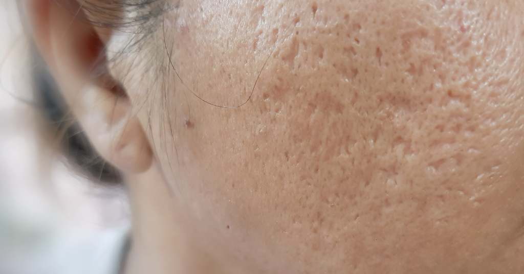 Skin Purging Vs Skin Breakouts