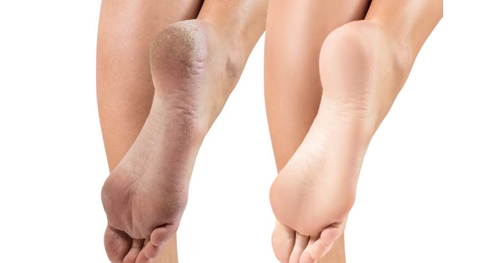 dry and cracked feet