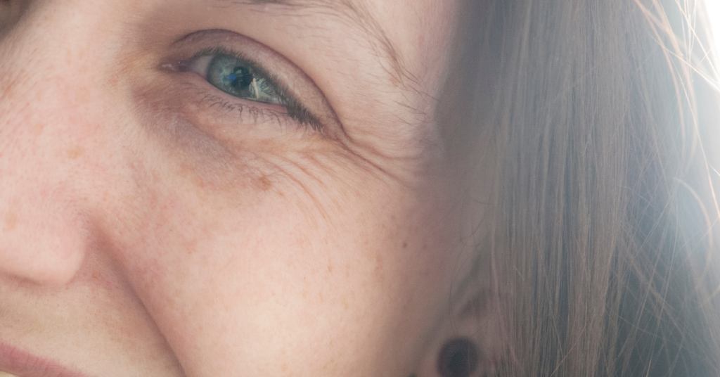 Puffy Eyes and Dark Circles