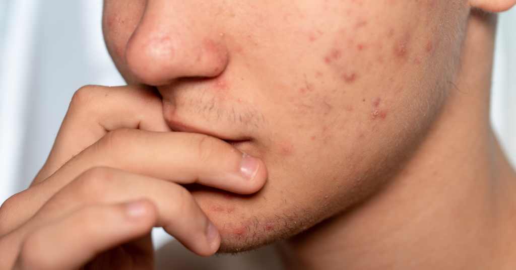 Acne Prone Skin