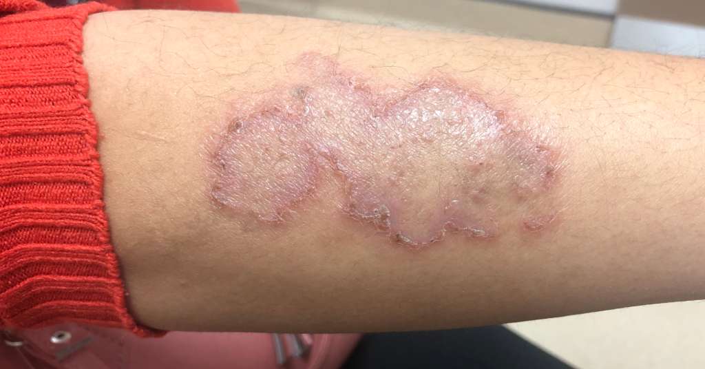 Eczema