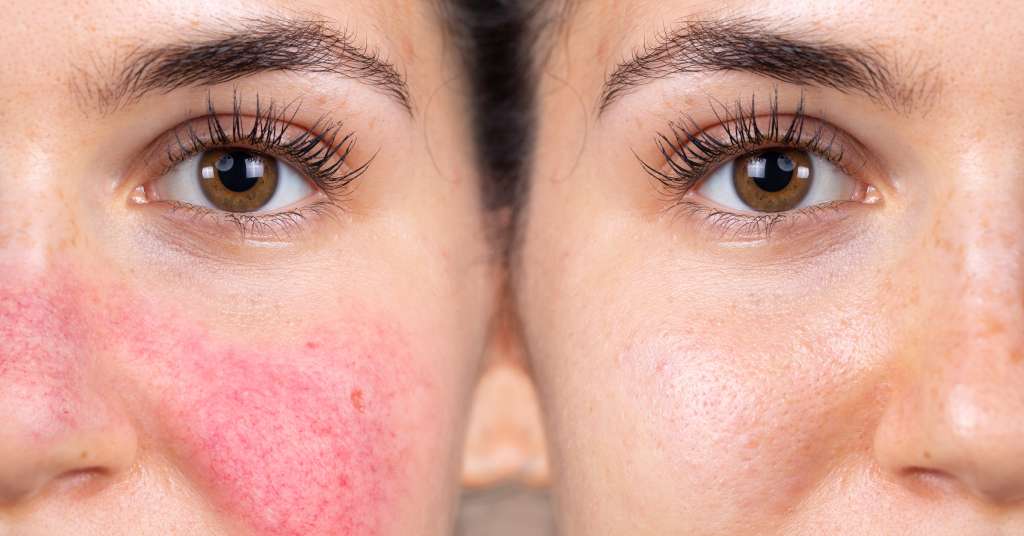 Post Inflammatory Erythema