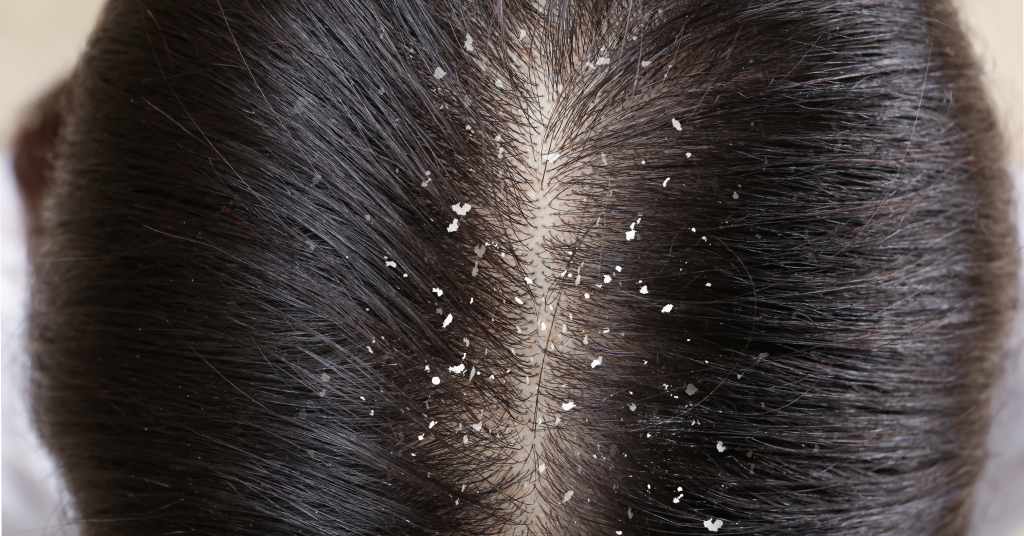 Best Anti Dandruff Shampoo