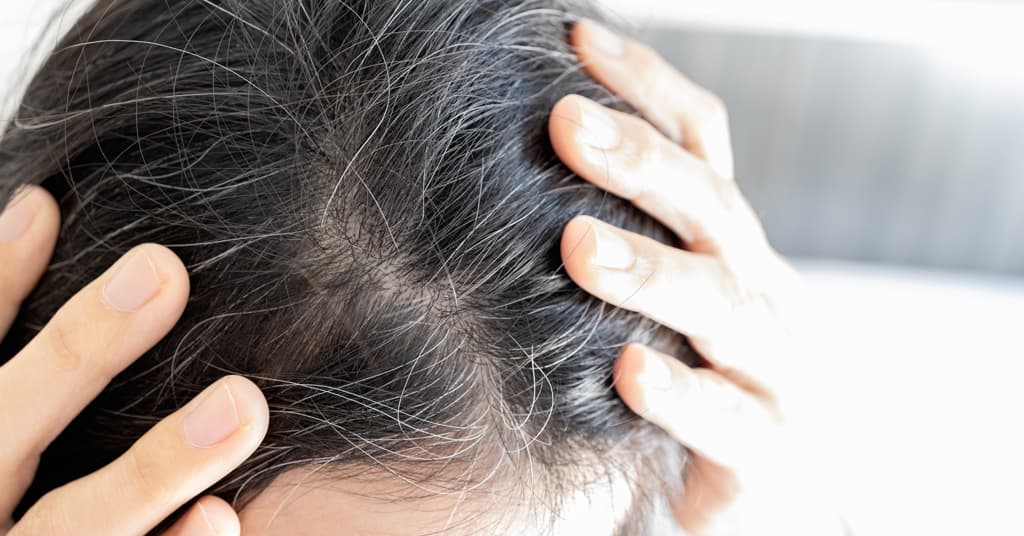 Dry Scalp during winter