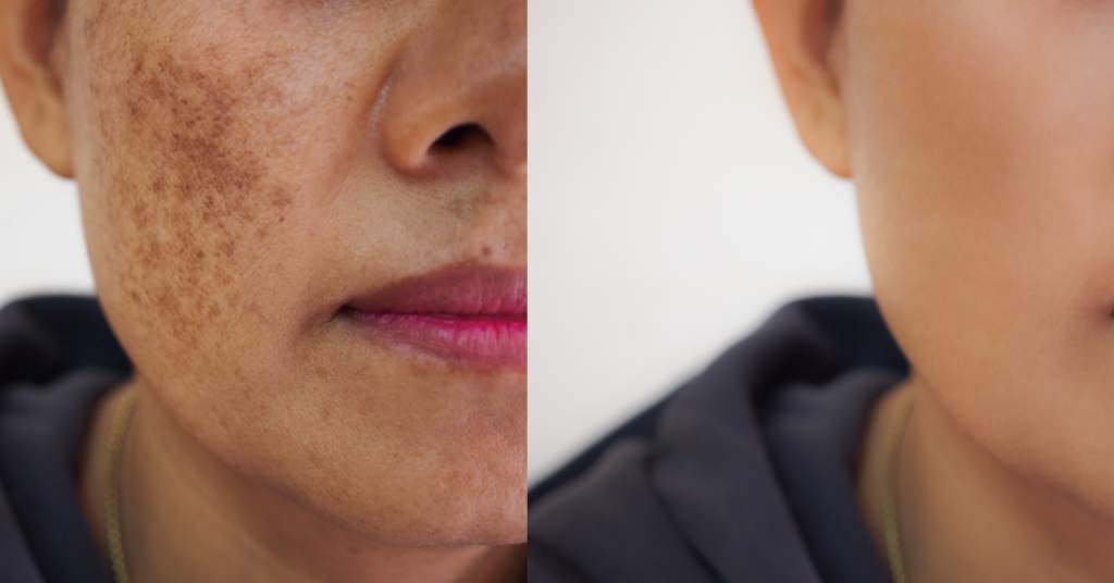 hyperpigmentation and dark spots
