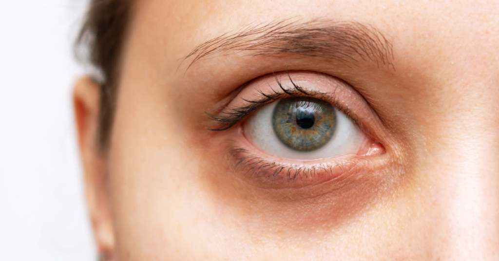 What causes Dark Circles