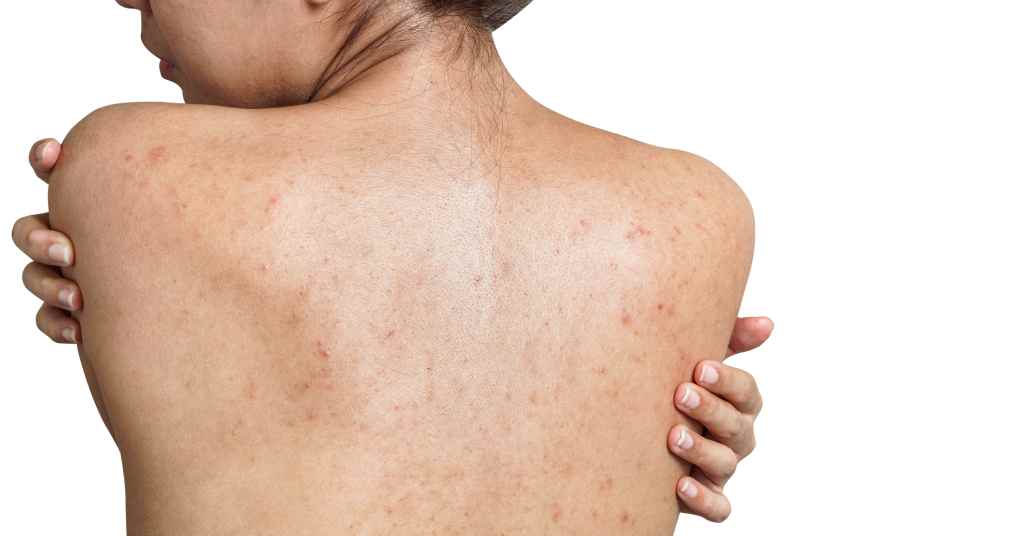 back acne