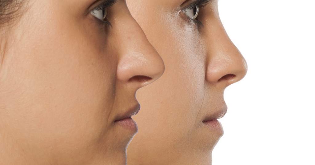 How to Remove Dark Circles in 2025