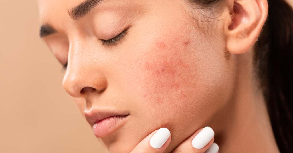 Rosacea