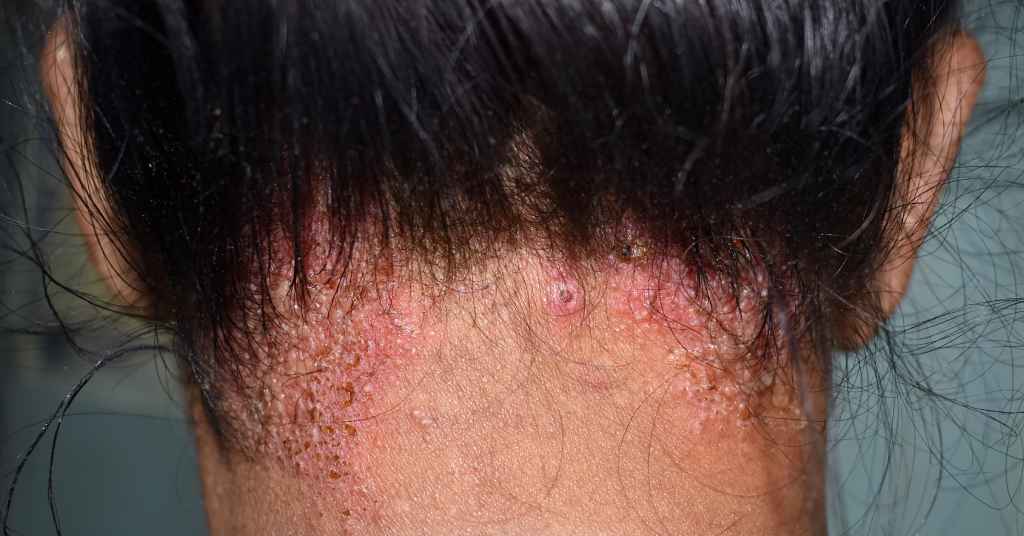 scalp psoriasis