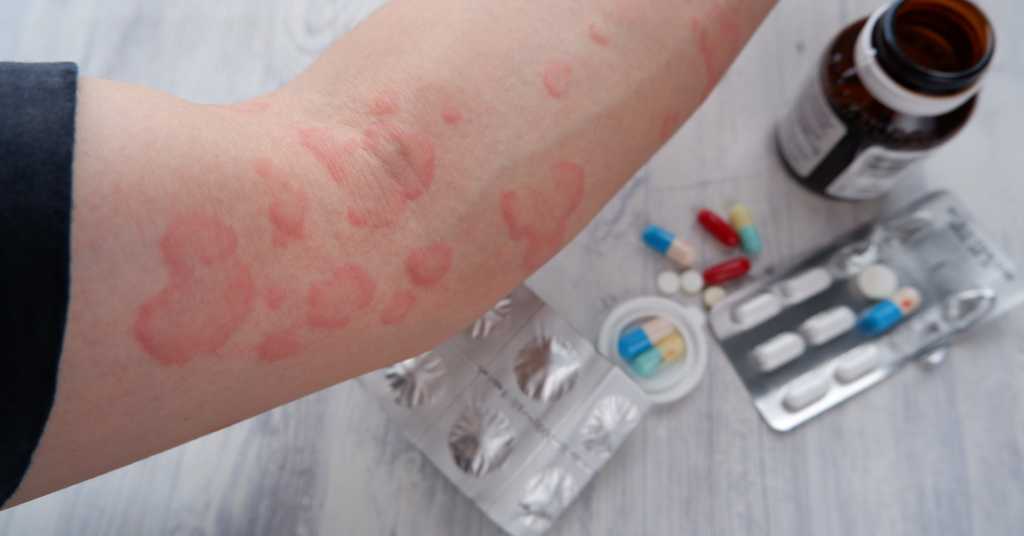 eczema flare ups