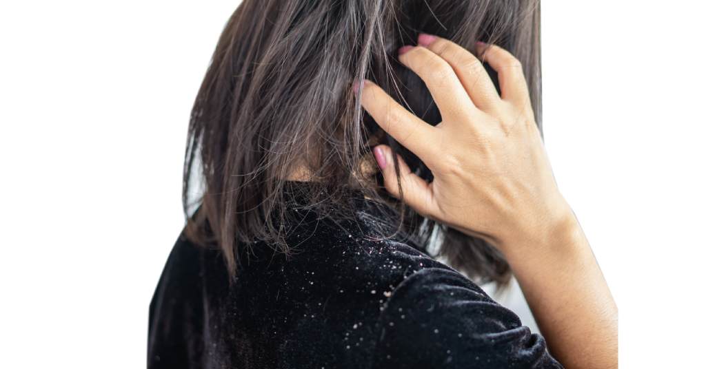 Dandruff Vs Dry Scalp