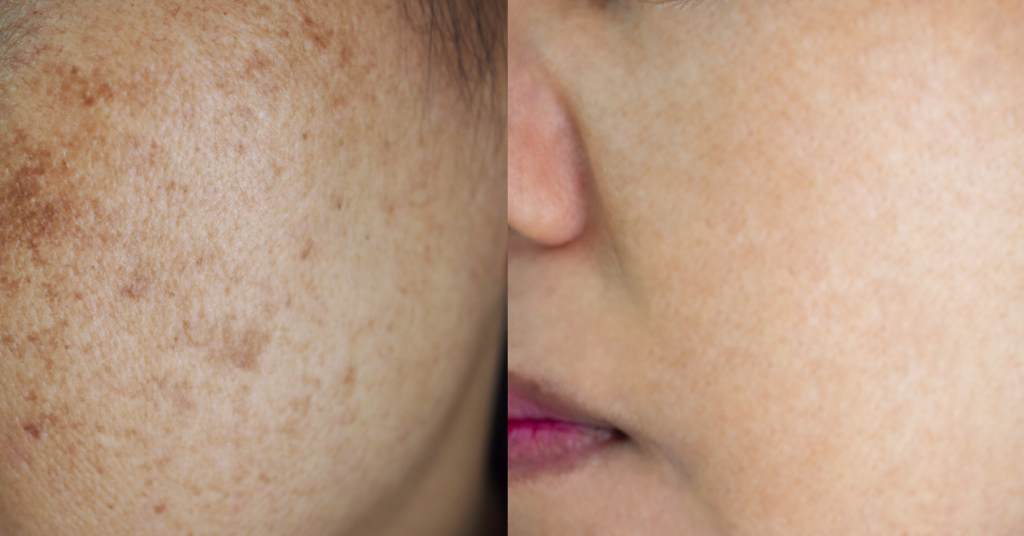 different types of dark spots