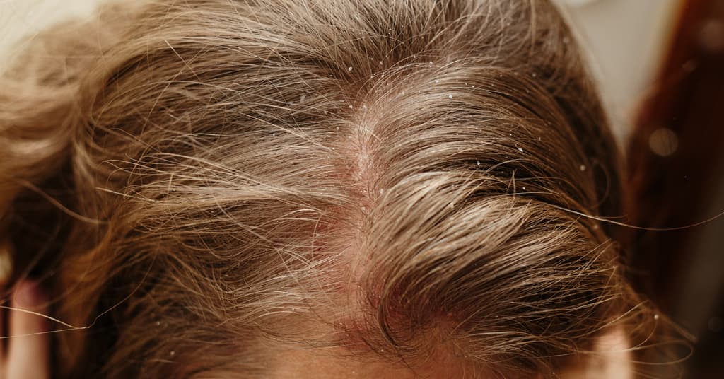 Scalp Psoriasis
