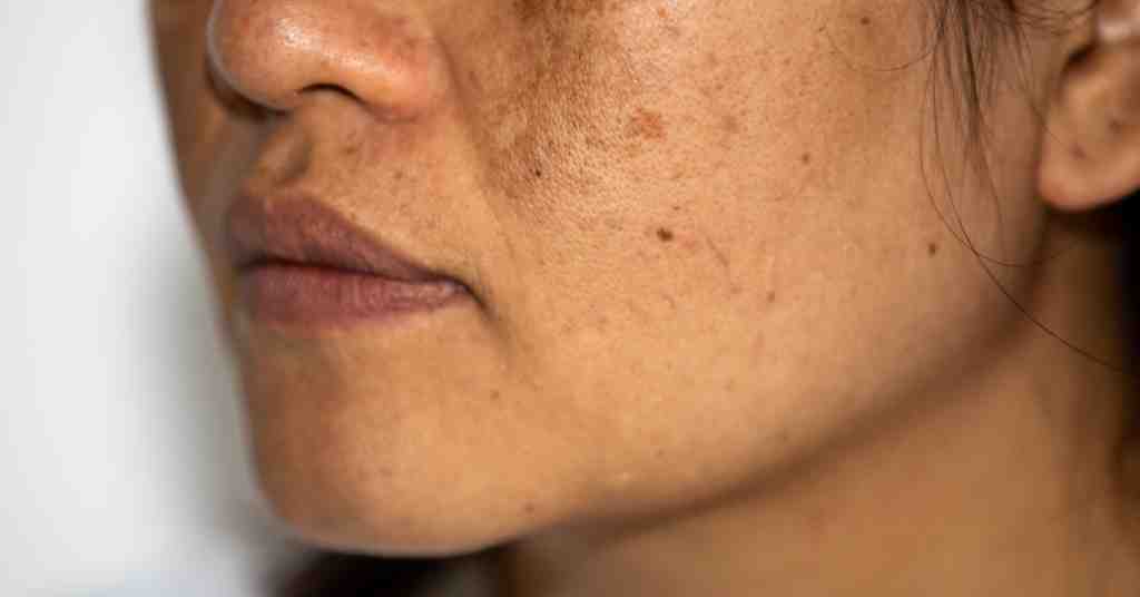 get rid of uneven skin tone