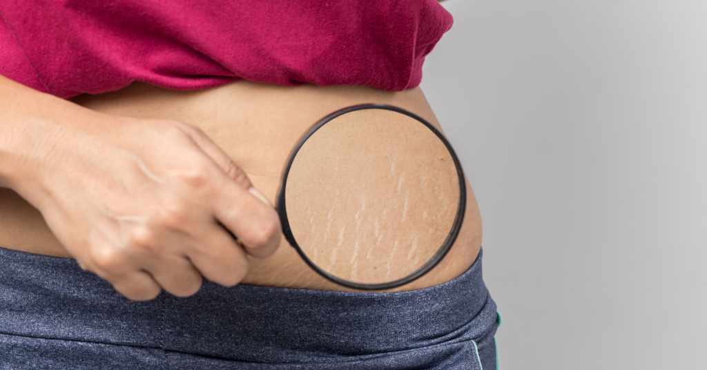 Stretch marks