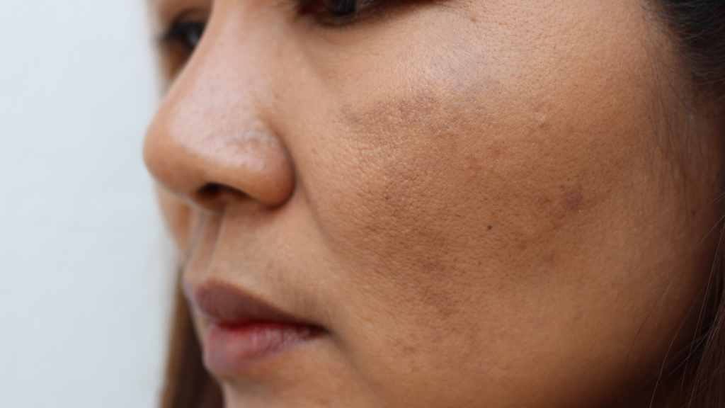 get rid of wrinkles at home