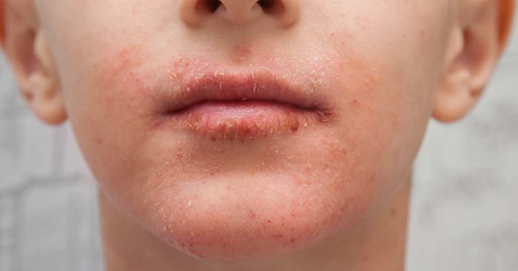 remove dead skin from face