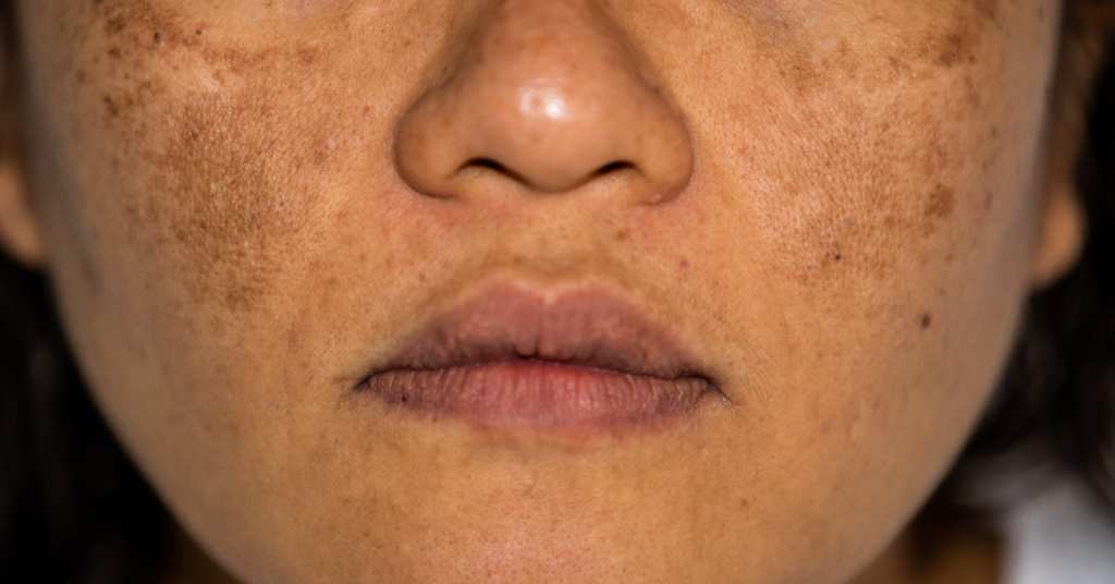 Melasma