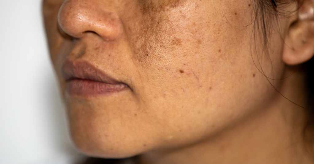 Home Remedies For Skin Pigmentation