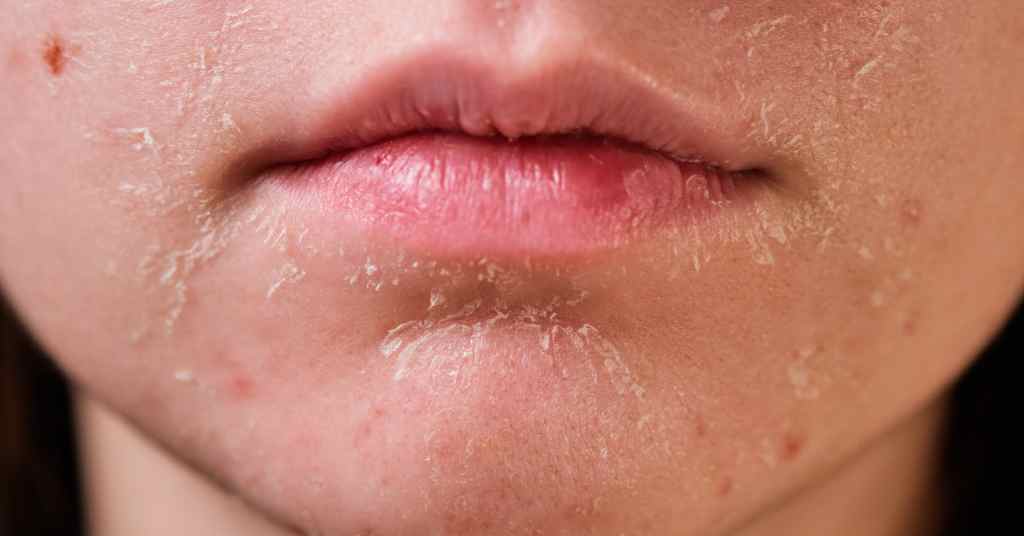 How To Avoid Dry Skin