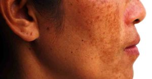 What is pigmentation and its various treatments