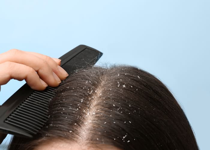 Pro Tip 2 Decode Flakes Before Treating Them